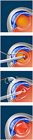 Cataract Surgery Beaufort